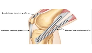 How to Choose Your ACL Graft?