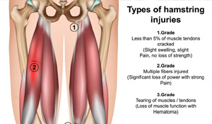 Platelet Rich Plasma (PRP) for Hamstring Injuries