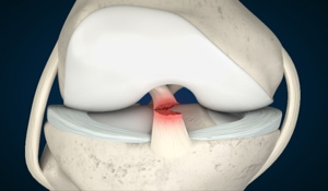 The Latest Advancements in ACL Surgery and Treatment