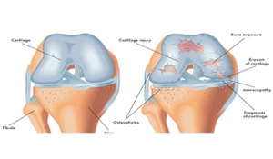 What are My Cartilage Implant Options?