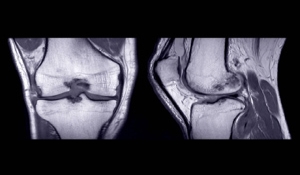 What Imaging is Needed for ACL Revision Surgery?