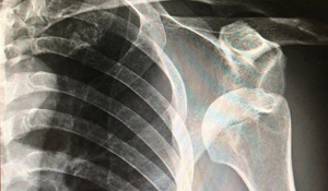 What is a Bony Bankart Lesion (Shoulder Dislocation)?