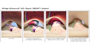 What is the BEAR ACL Procedure?