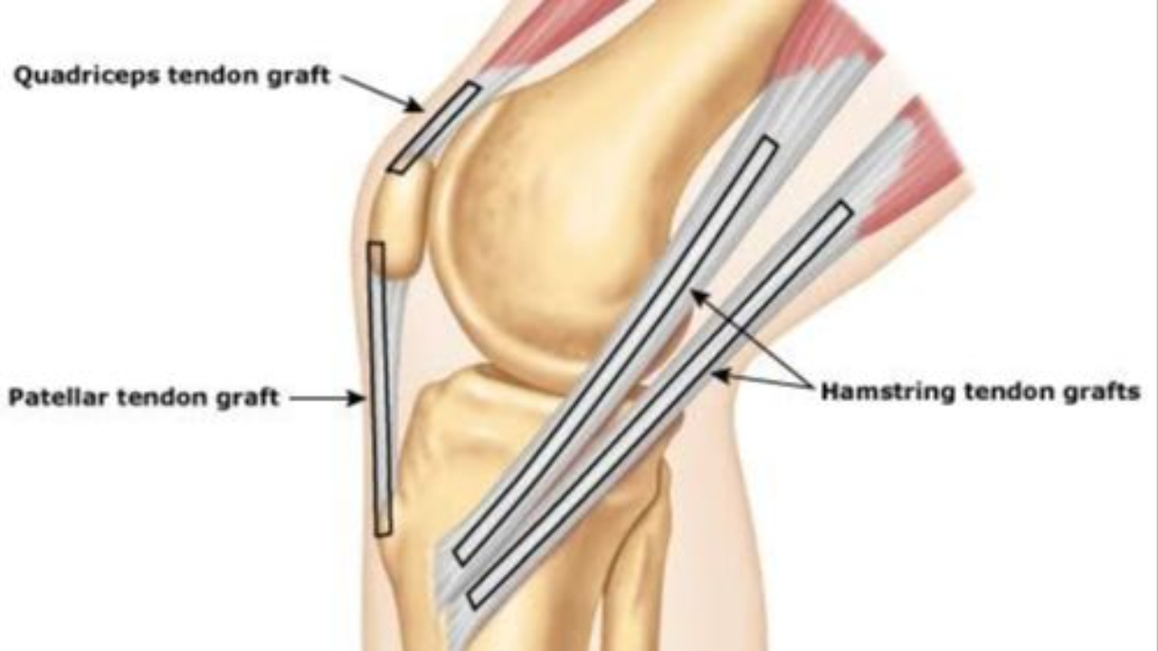 How to Choose Your ACL Graft?