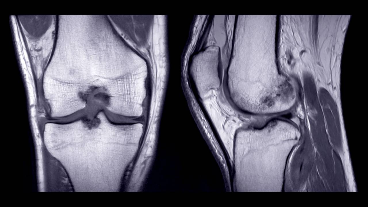 What Imaging is Needed for ACL Revision Surgery?