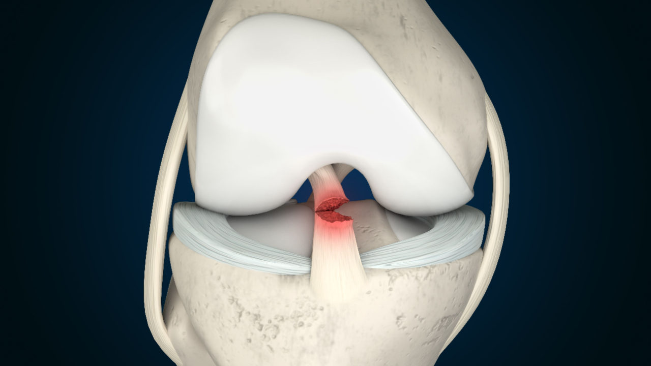 The Latest Advancements in ACL Surgery and Treatment