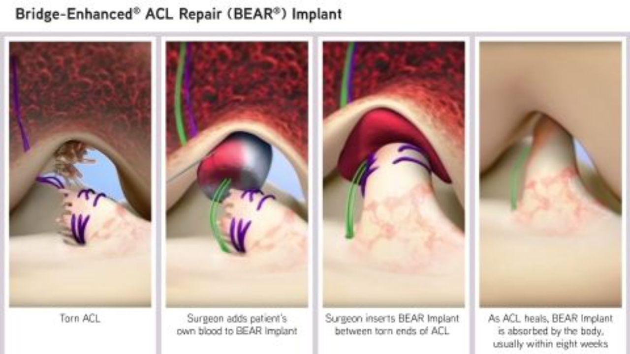 What is the BEAR ACL Procedure?