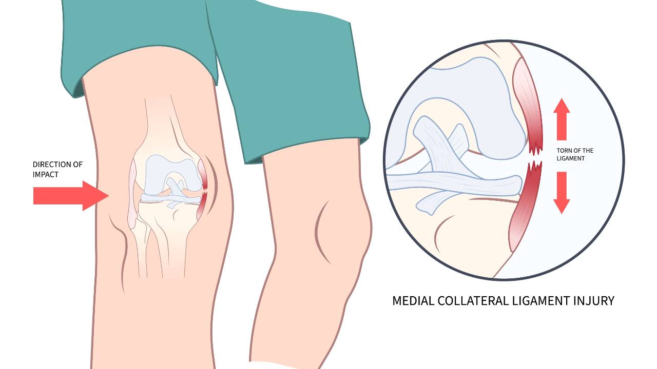 Does PRP help heal MCL injuries?