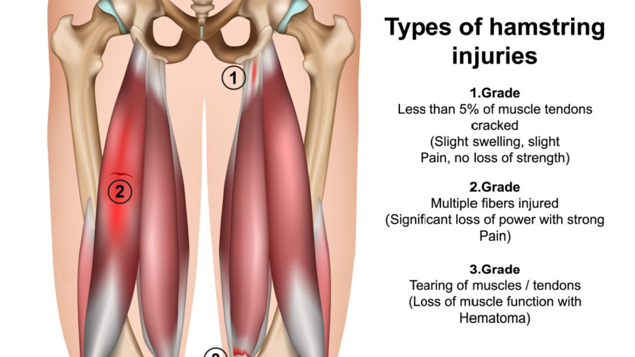 Platelet Rich Plasma (PRP) for Hamstring Injuries